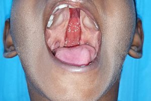 CLEFT LIP AND CLEFT PALATE SURGERIES IN BIRRD