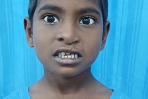 CLEFT LIP AND CLEFT PALATE SURGERIES IN BIRRD1